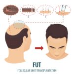 Haartransplantation Methoden