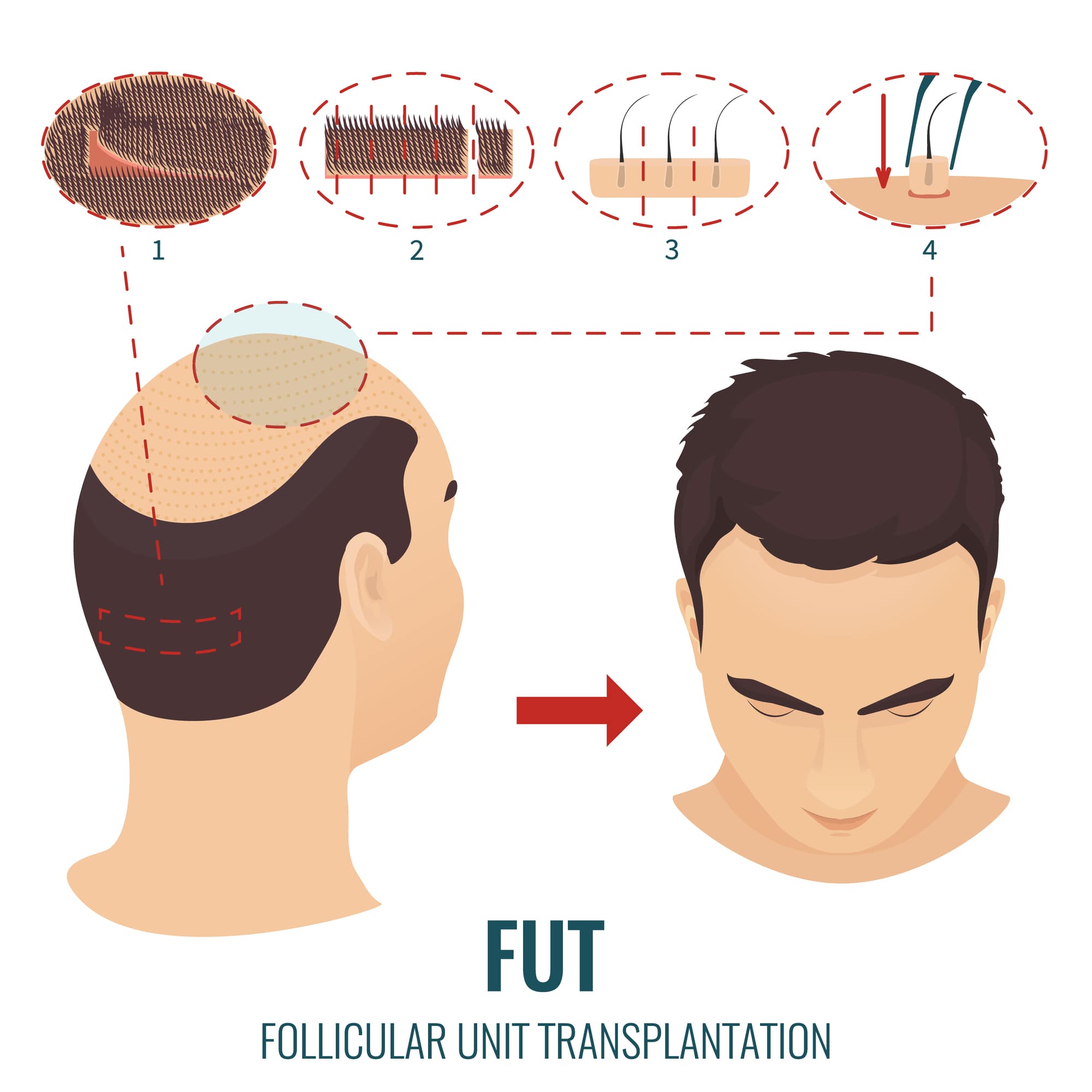 Haartransplantation kosten für Kosten einer